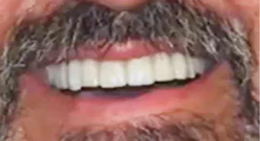 Smile Gallery | Apex Dental Studio Transformations