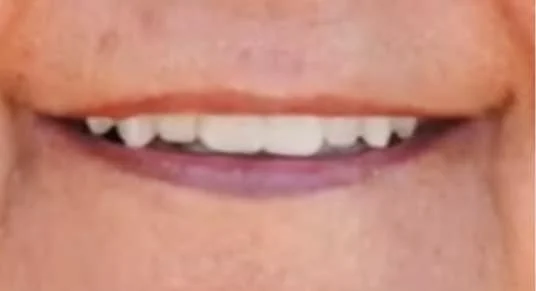 Smile Gallery | Apex Dental Studio Transformations