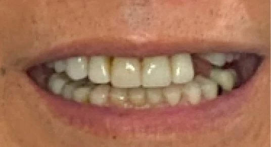 Smile Gallery | Apex Dental Studio Transformations