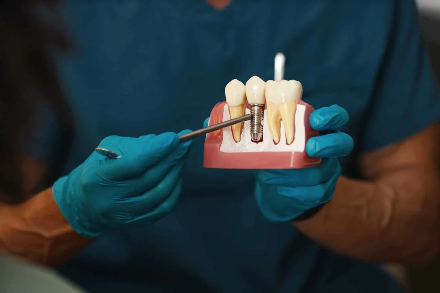 illustrating-dental-implant-procedure-model