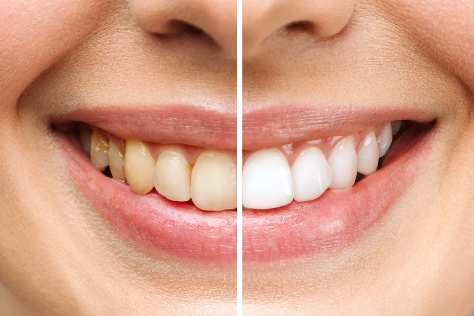 Woman teeth before and after whitening