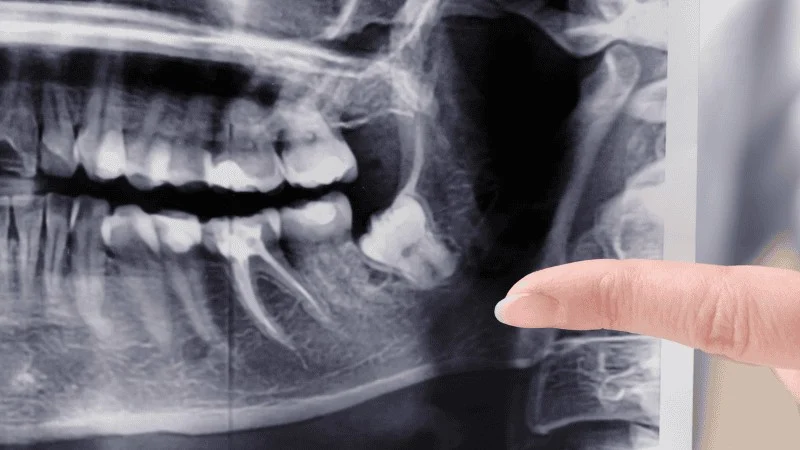 dental implants with bone loss