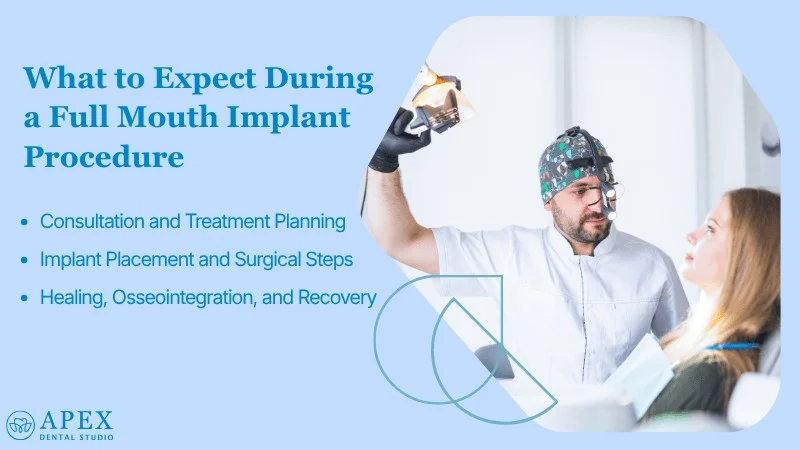 The Full Mouth Dental Implant Procedure What to Expect