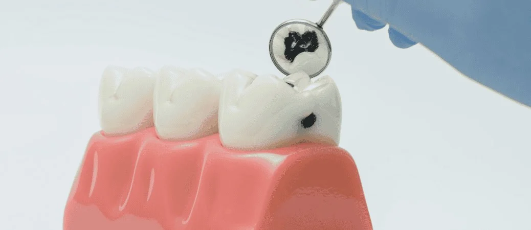 Curodont cavity treatment