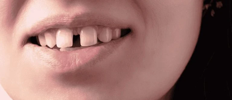 Bioclear for black triangles between teeth