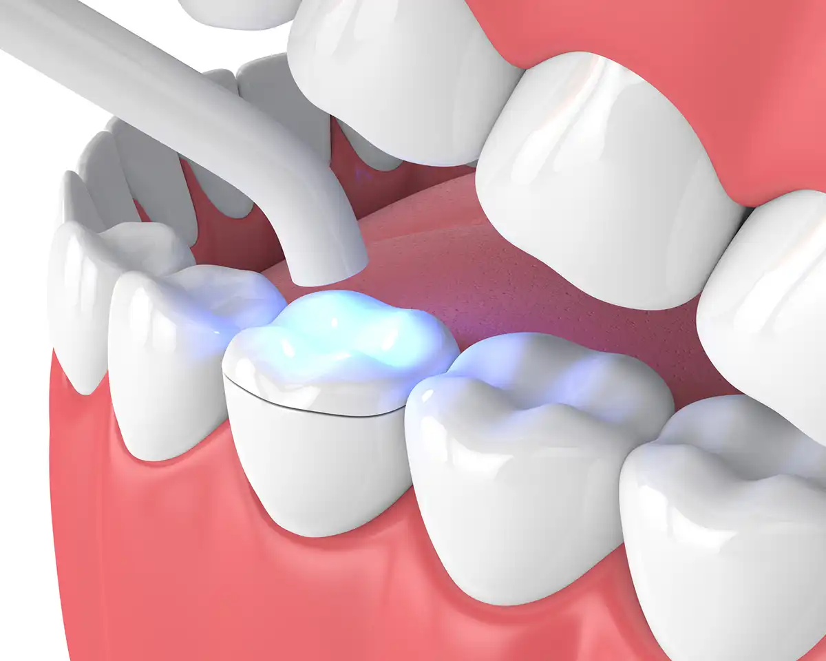 Dental Bonding
